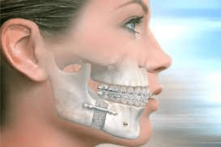 protetik diş tedavisinin hastalarda nasıl gözüktüğü hakkında 3 boyutlu bir çalışma