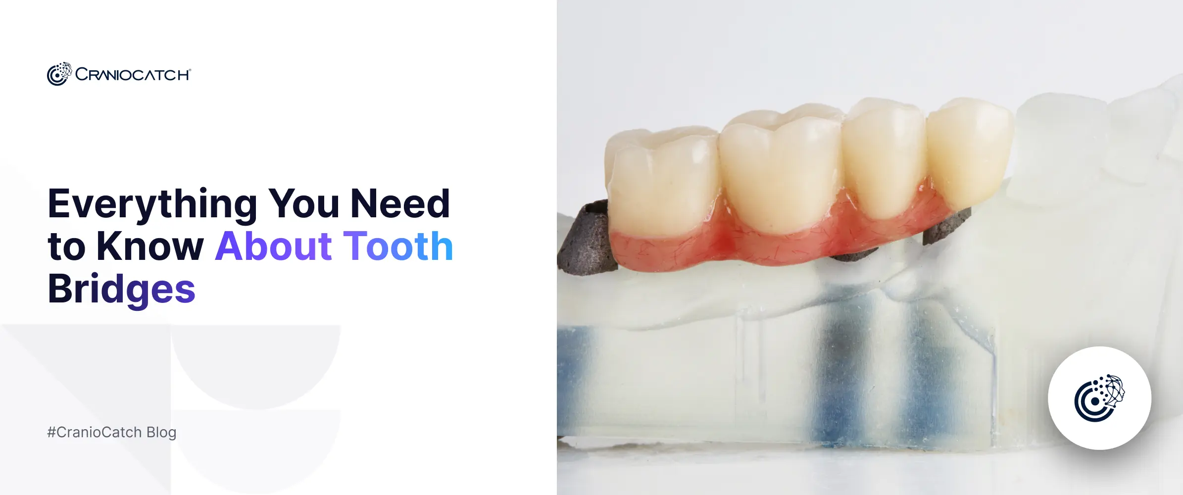 Everything You Need to Know About Tooth Bridges
