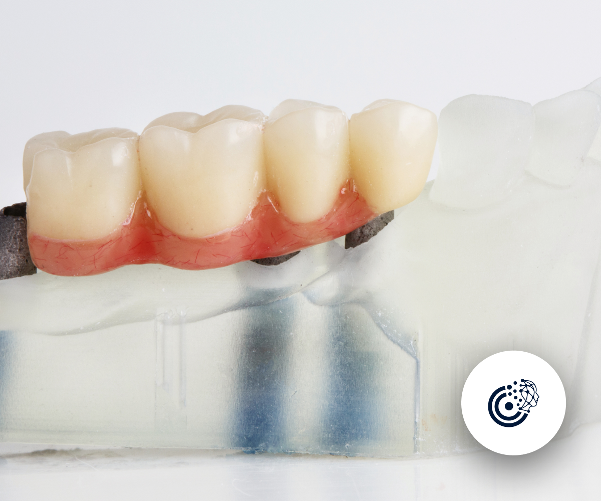 Everything You Need to Know About Tooth Bridges