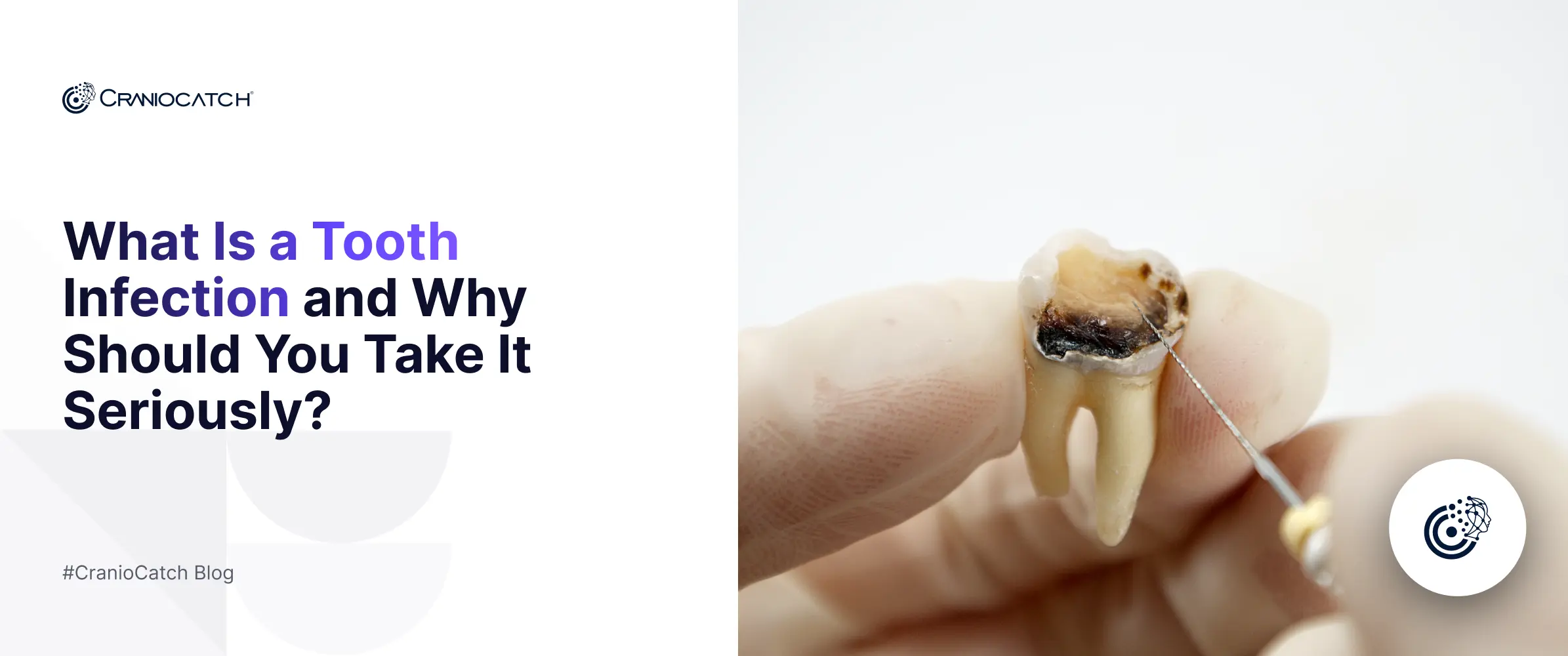 What Is a Tooth Infection and Why Should You Take It Seriously?
