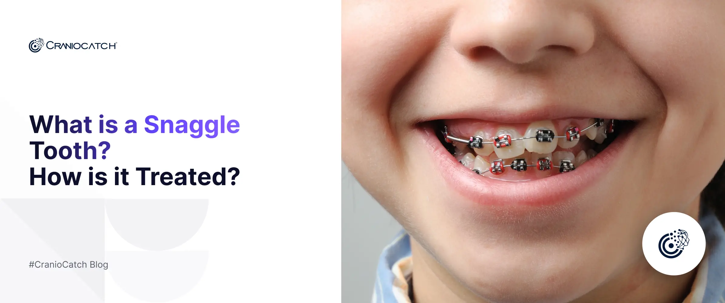 What is a Snaggle Tooth? How is it Treated?
