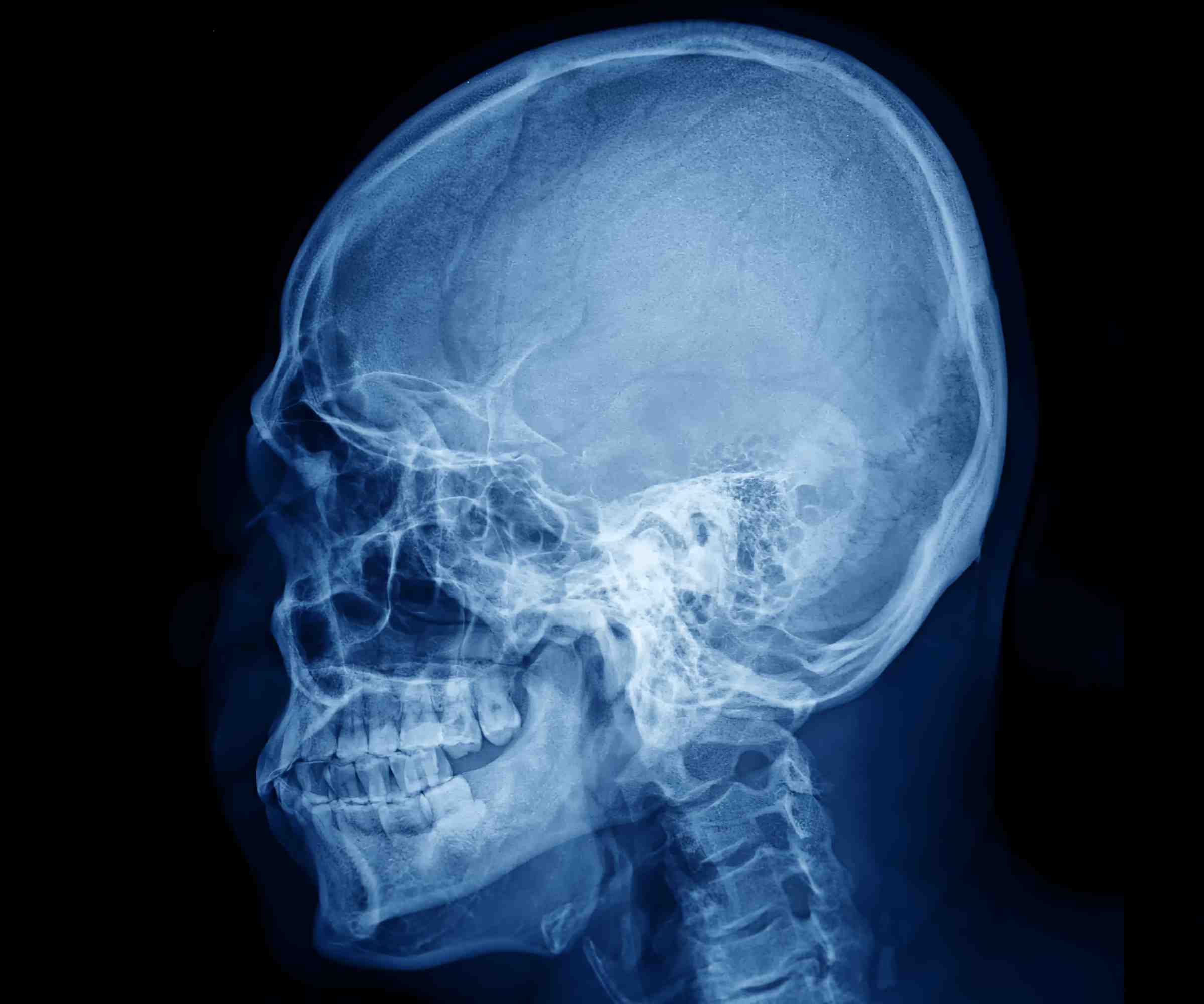 What Is A Cephalometric X-Ray? | CranioCatch