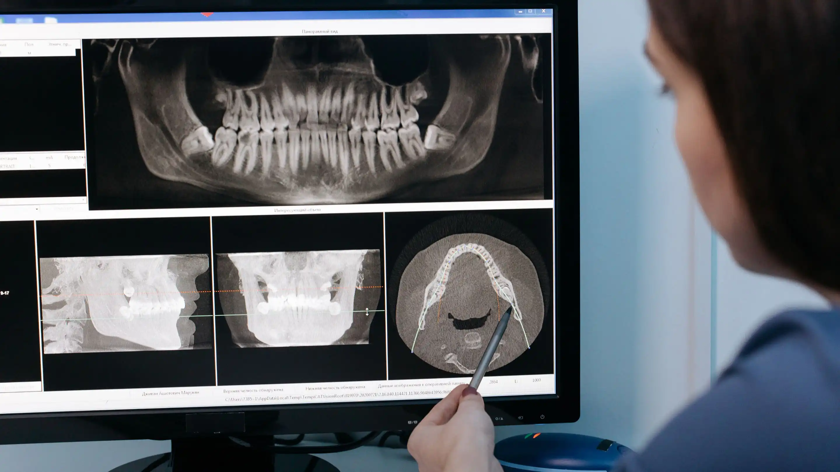 Cone Beam CT Tarayıcı Radyasyonu – Güvenli ve Etkili Diş Görüntüleme