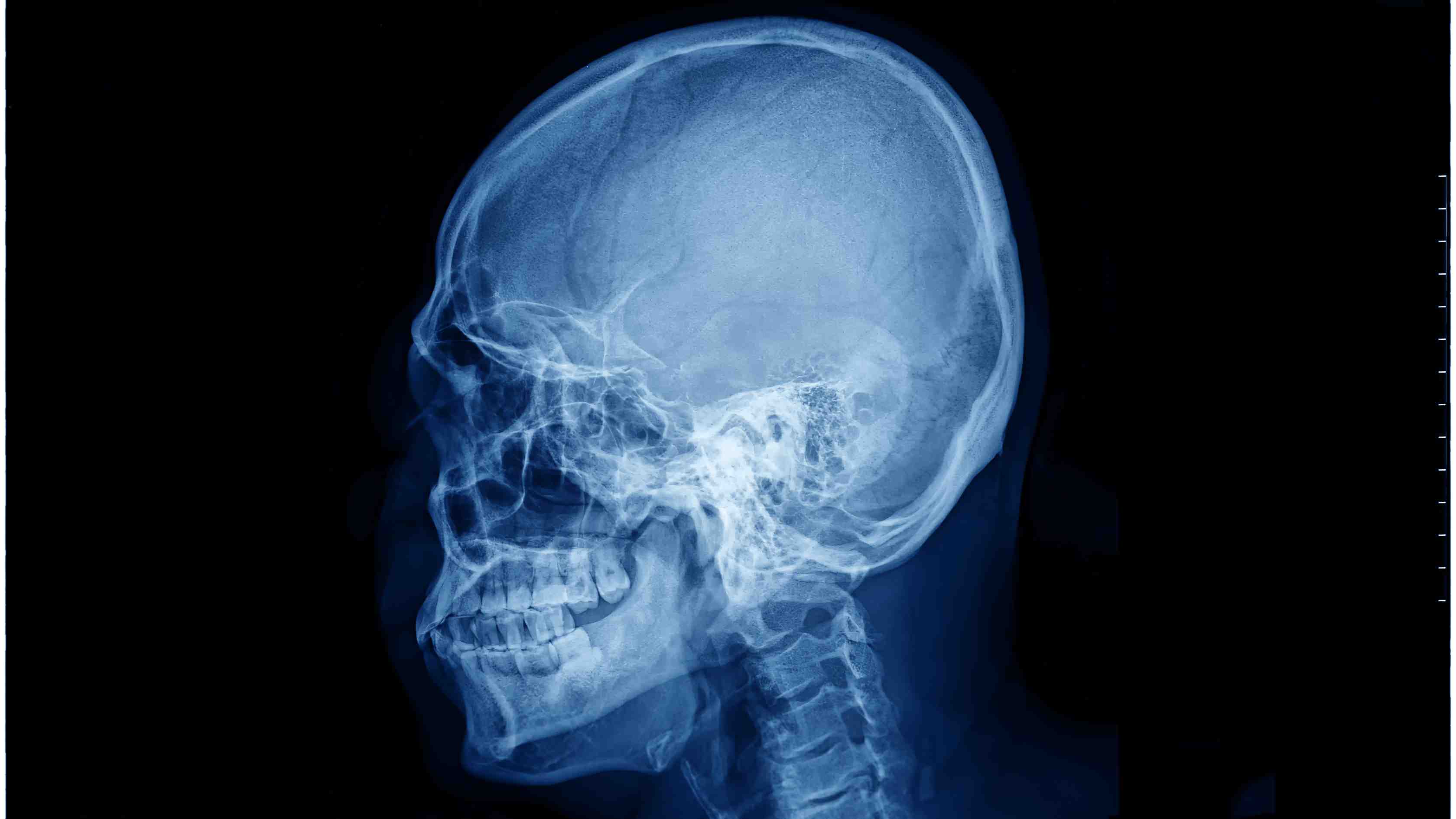 Lateral cephalometric x-ray used in cephalometric imaging for dental assessments